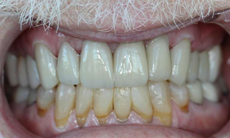 A-Senior-Smile-Transformation-After-Image