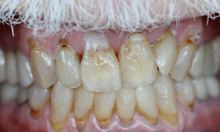 A-Senior-Smile-Transformation-Before-Image